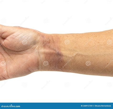 Hot Water Burn On The Skin Of The Hand Stock Image Image Of Heat Treatment 268912769