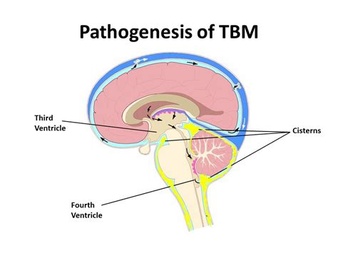 Pediatric Dr Tb Meningitis A Case Based Discussion Youtube