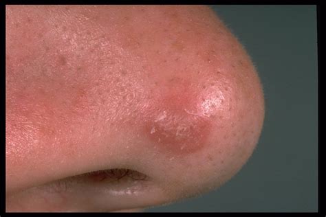 So if you noticed that a mole is changing in any of the ways. Melanoma : Definition, Appearance and Treatment