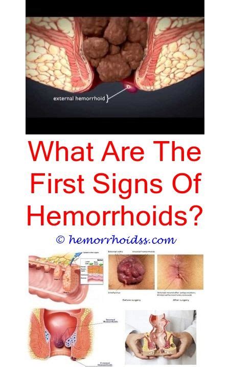 Pin On Internal Hemorrhoids