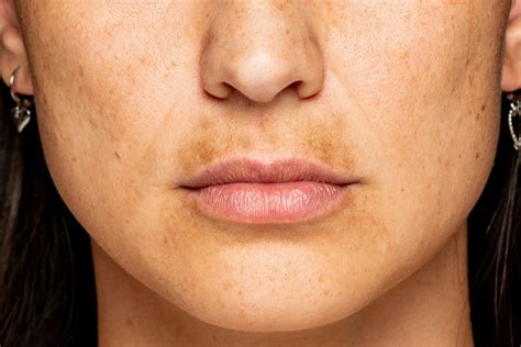 What Is Skin Discoloration Causes And Symptoms