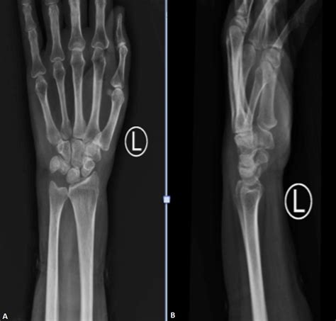 Cureus Tuberculosis Of The Left Wrist Joint And Spine