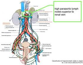 Safe Dissection Of High Paraaortic Lymph Nodes Superior To The Renal