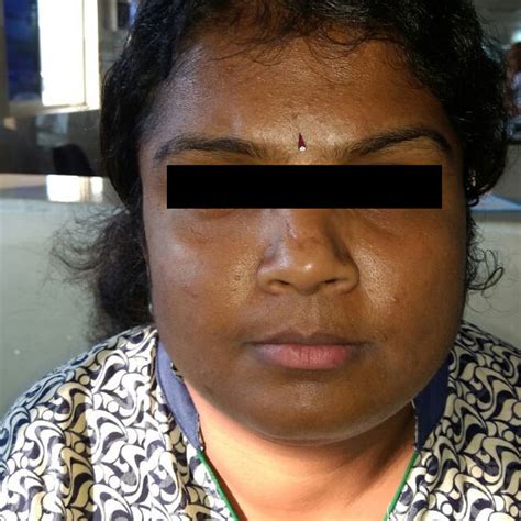 Clinical Picture Showing Diffuse Swelling Of The Face Download