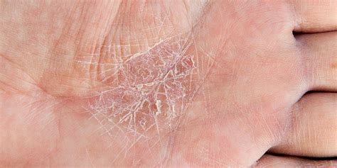 6 Eczema Symptoms You Should Bring Up With Your Derm Self