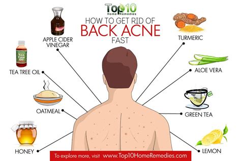 How To Get Rid Of Back Acne Top 10 Home Remedies
