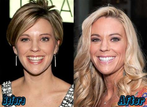 Kate Gosselin Plastic Surgery Before And After Photos