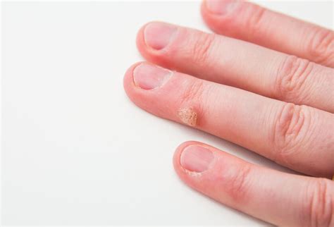 How To Treat Warts In Children Lowvelder