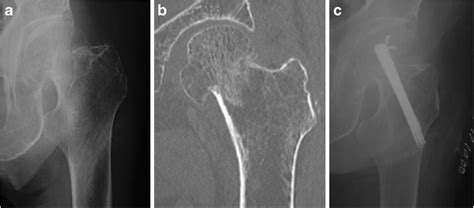 Radiograph A And Ct Imaging B Show A Garden Type Ii Displaced
