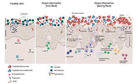 Atopic Dermatitis And The Skin Microbiome Immunopaedia