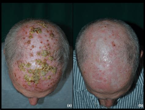 Patient 2 With Erosive Pustular Dermatosis Of The Scalp A Diffuse
