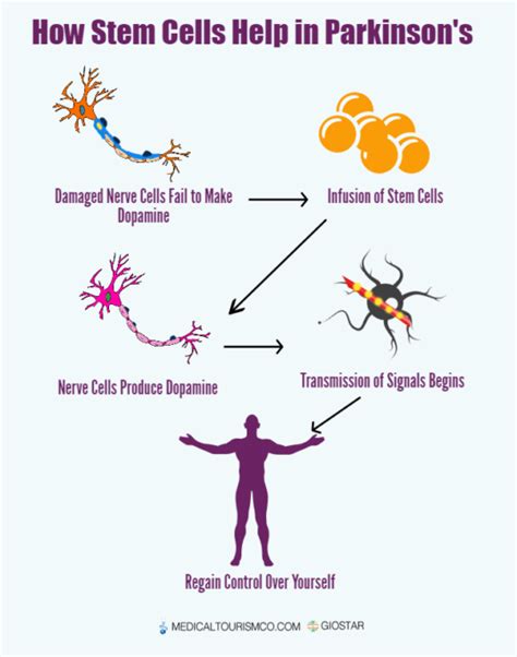 Stem Cells Treatment Parkinsons Infographic