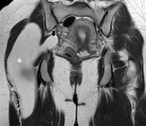 Cureus Accidental Ultrasound Finding Of A Giant Intermuscular Gluteal