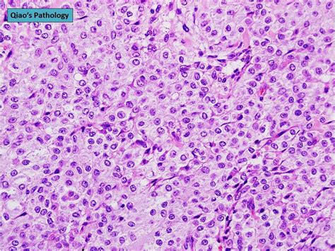 Qiaos Pathology Adult Granulosa Cell Tumor Of Ovary Flickr