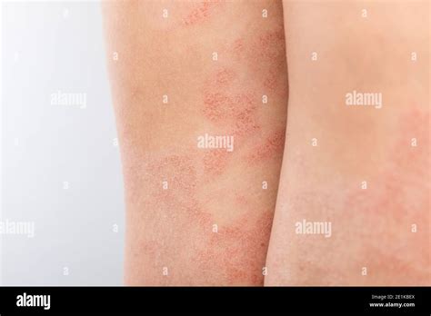 Acute Atopic Dermatitis On The Legs Behind The Knees Of A Child Is A