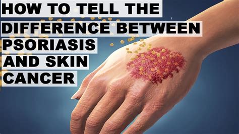 How To Tell The Difference Between Psoriasis And Skin Cancersigns Of