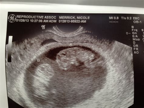 I had my first ultrasound sharing both my 4 week 4 days. The Merrick Twins: 9 week 6 day ultrasound