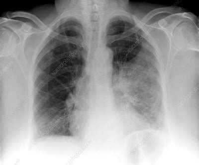 Pathological anatomy of 'atypical pneumonia, etiology undetermined': Pneumonia Xray With A Patch - risk-games's blog