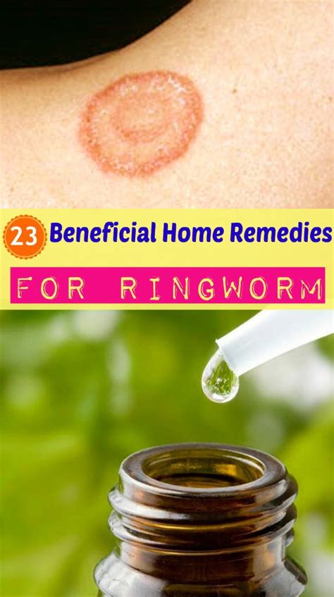 Homeremedyshop 23 Beneficial Home Remedies For Ringworm Home