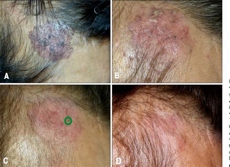 Early Superficial Basal Cell Carcinoma
