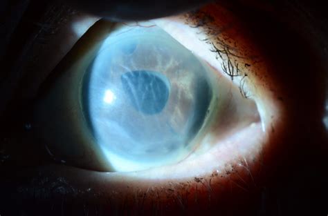 Corneal Swelling Following Cataract Surgery Wills Eye Hospital