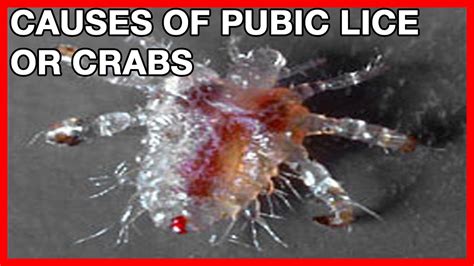 Crabs Std Causes Symptoms And Treatment Of Pubic Lice Self Hot Sex Picture