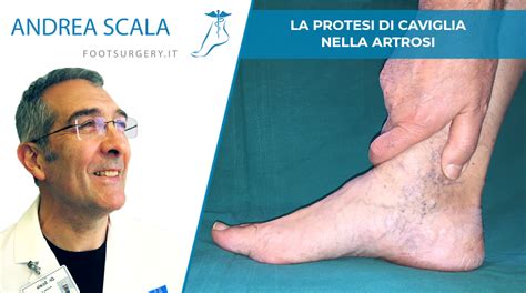 La Protesi Di Caviglia Nella Artrosi Dott Andrea Scala