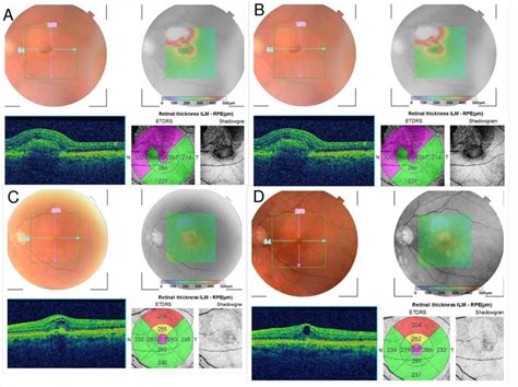 Two Year Outcomes Of Intravitreal Ziv Aflibercept British Journal Of