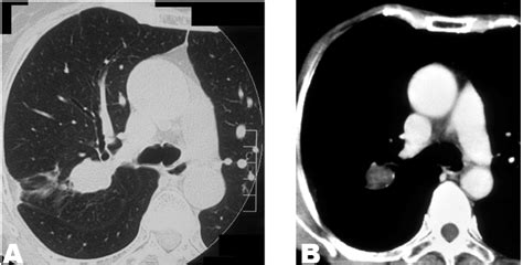 Full Text Intrapulmonary Bronchogenic Cyst Mimicking Primary Lung