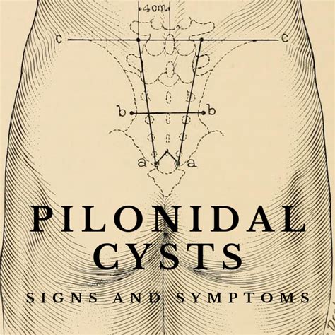 Diagram Of Pilonidal Cyst