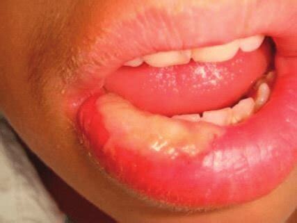 Sore On Inside Of Lip After Dental Work Infoupdate Org