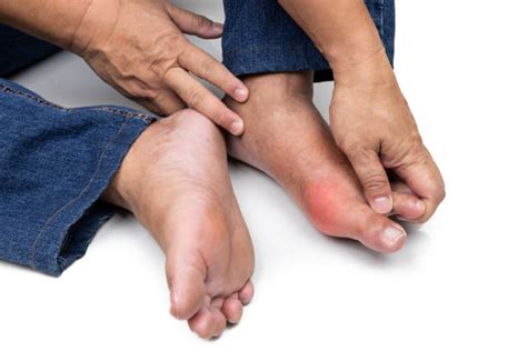 Feet Deformed From Rheumatoid Arthritis Stock Photos Pictures