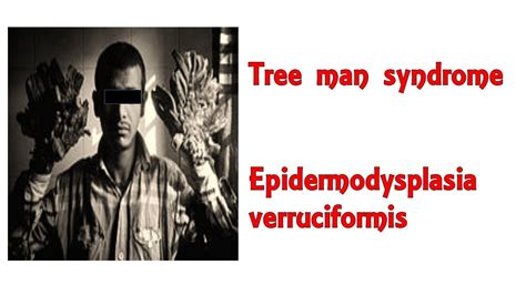 Tree Man Syndrome Rare Skin Disease Due To Hyper Susceptibility To