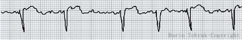 Ritmo cardiaco eccezionalmente rapido e irregolare dovuto ad una propagazione caotica dei segnali elettrici nei ventricoli che ne impedendisce l'efficace la contrazione. Le principali aritmie cardiache al tracciato Ecg spiegate ...