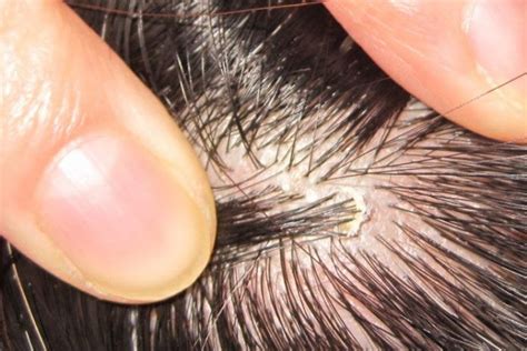 Pin On Scalp Acne