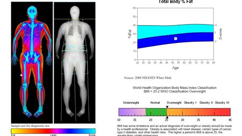 Dxa Report Explanation Whole Body Scan Youtube