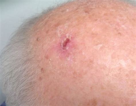 Derm Dx A New Scalp Lesion In A Man With A History Of Cancer
