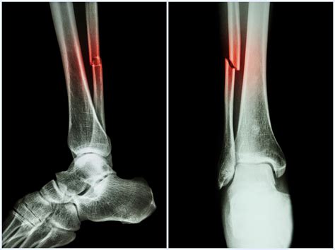 Fracture Shaft Of Fibula Bone Leg Bone X Ray Of Leg 2 P