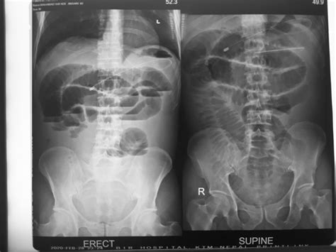 Plain X Ray Abdomen Showing Dilated Bowel Loops Multiple Air Fluid