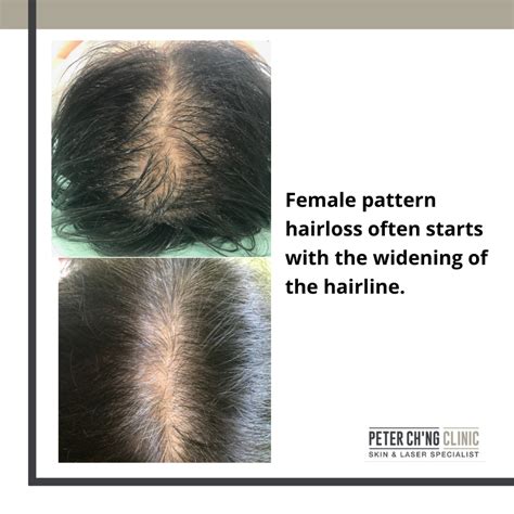 birth control hair loss recovery denae dominguez