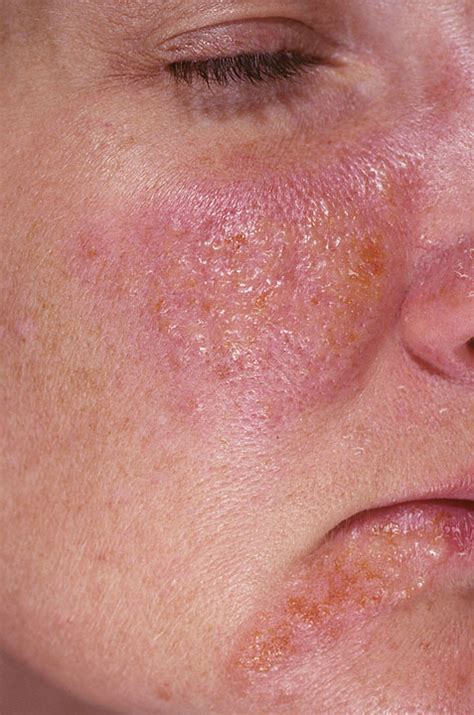 Guttate Psoriasis Causes Symptoms Treatment Pictures Cure Home