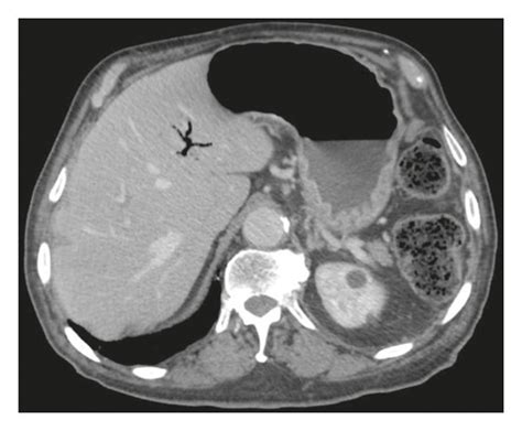 Unenhanced Computed Tomography In The Same Case Of Bouverets Syndrome