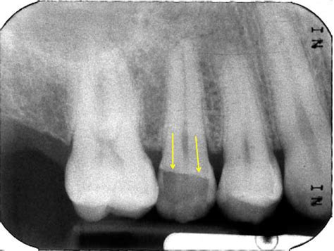 Case of the Week: Coronal fracture - Dr. G's Toothpix