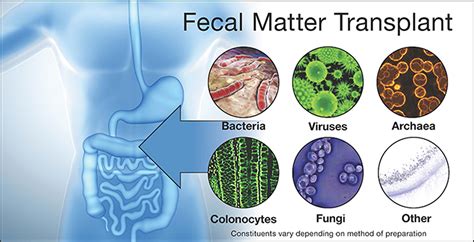 Fecal Transplant Current Uses Side Effects And Fda Regulations