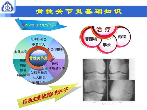 骨性关节炎的手术治疗策略，都在这篇课件里！ 好医术早读文章 好医术 赋能医生守护生命