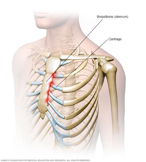 Costochondritis Disease Reference Guide