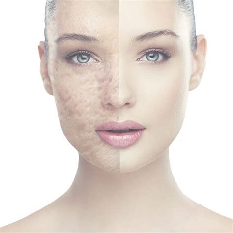 Acne Scars And Treatments Utah Valley Dermatology