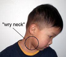 Torticollis Wry Neck Physical Therapy Cyberpt