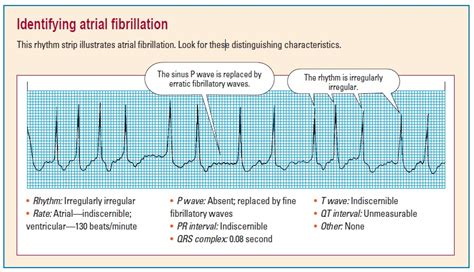 Plab King Ecg For Plab