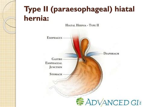 Ppt Endoscopic Diagnosis Of Hiatal Hernia Powerpoint Presentation